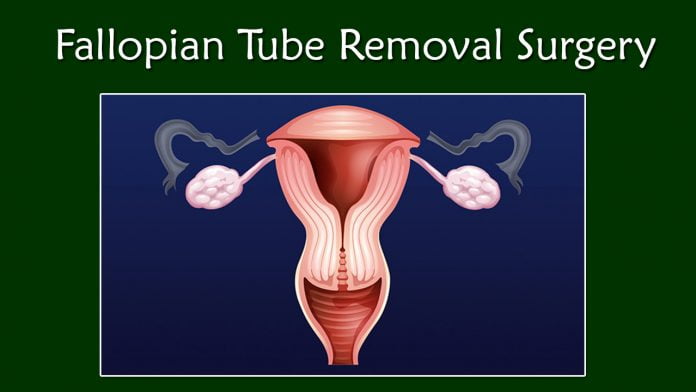 fellopian tube removal surgery 2021